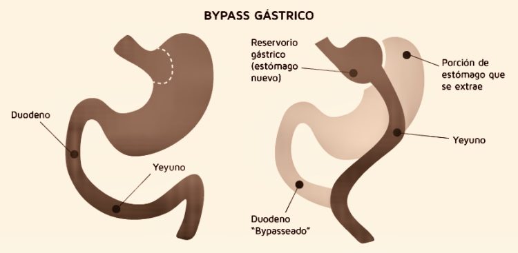 La cirugía de bypass gástrico conduce a la remisión de la diabetes a